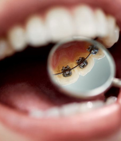 Mirror in patient’s mouth showing lingual braces