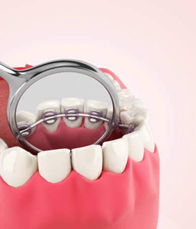 Illustration of dental mirror showing lingual braces