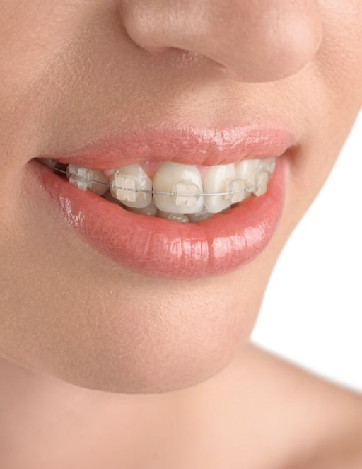 Close up of smile with clear ceramic braces in Houston