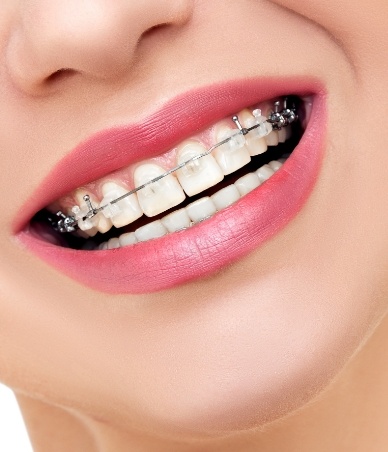 Close up of person with clear ceramic braces smiling