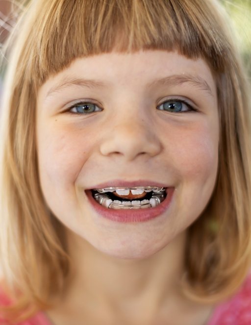 Young girl grinning with braces for dentofacial orthopedics in Houston