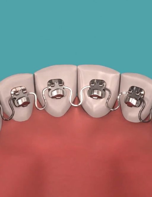Illustrated InBrace lingual braces on the backs of a row of teeth