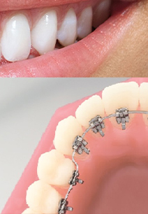 Close up of smile with braces only on inner side of teeth