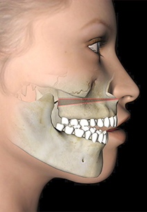 Illustrated side profile of face showing jawbones