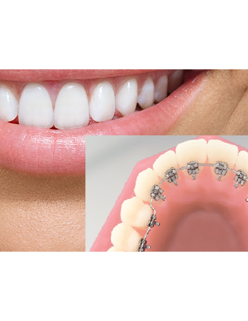 Close up of smile with lingual braces in Houston on backs of teeth