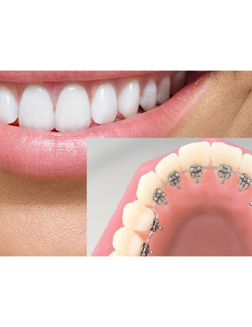 Lingual Braces Houston, TX, Adult Braces