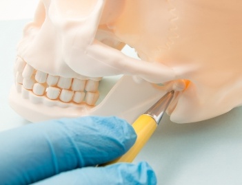 patient wearing a Custom Occlusal Splints