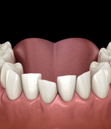 Digital illustration of crowded, crooked teeth