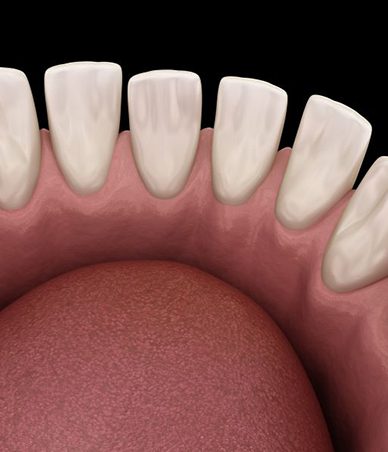 Digital illustration of an overbite