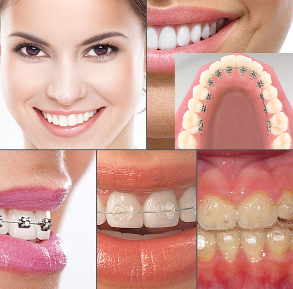 Collage of smiles with braces and other orthodontic services in Houston