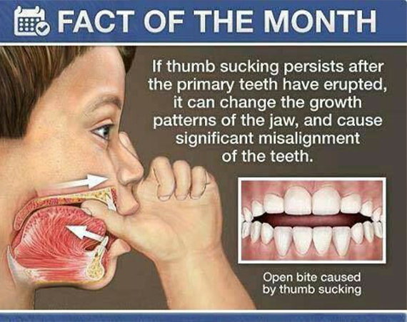 Illustration of child sucking thumb with text explaining that thumb sucking after primary teeth have erupted can misalign the teeth