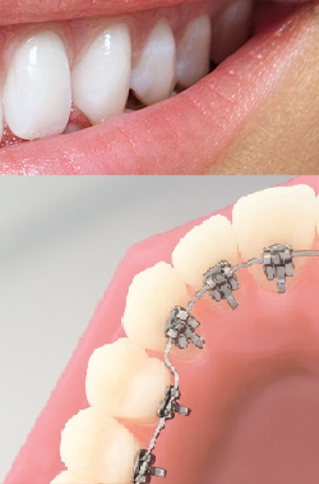 Close up of lingual braces on the back of row of teeth