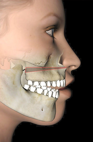 Side profile of face with illustration showing their jawbones and teeth