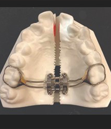 Model of the upper jaw split down the middle with metal wire connecting both halves