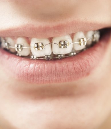 Close up of smile with traditional braces