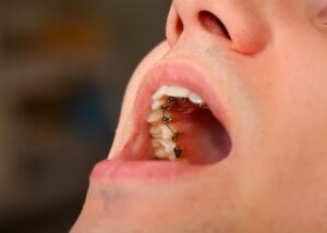 Close-up of patient’s teeth with lingual braces 