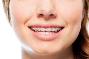 Close-up of woman’s smile with clear/ceramic braces 