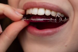 Close-up of woman placing retainer in her mouth 
